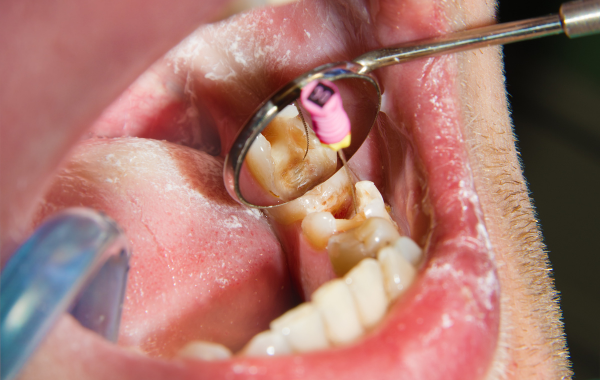 Dental Implants (2)
