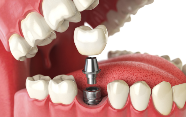 Dental Implants