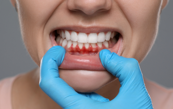 Gum treatment