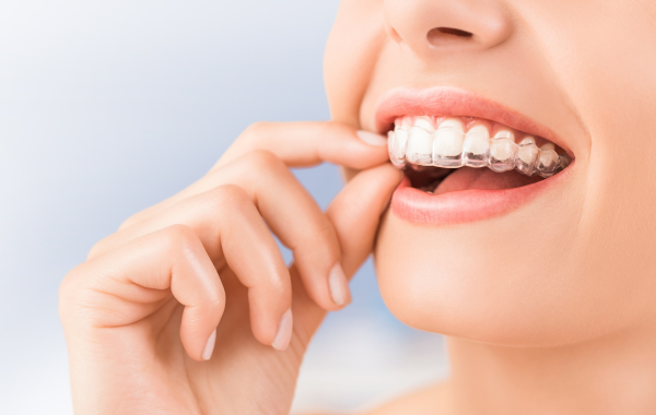 Invisible braces